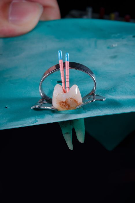 Zubní implantáty fotka